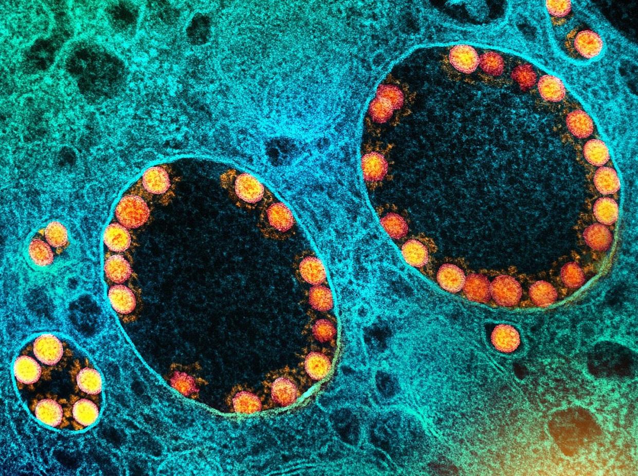 Partículas del virus SARS-CoV-2 (en amarillo) dentro de los endosomas de una célula epitelial nasal muy infectada. <a href="https://www.flickr.com/people/niaid/" rel="nofollow noopener" target="_blank" data-ylk="slk:National Institute of Allergy and Infectious Diseases (NIAID);elm:context_link;itc:0;sec:content-canvas" class="link ">National Institute of Allergy and Infectious Diseases (NIAID)</a>, <a href="http://creativecommons.org/licenses/by-sa/4.0/" rel="nofollow noopener" target="_blank" data-ylk="slk:CC BY-SA;elm:context_link;itc:0;sec:content-canvas" class="link ">CC BY-SA</a>