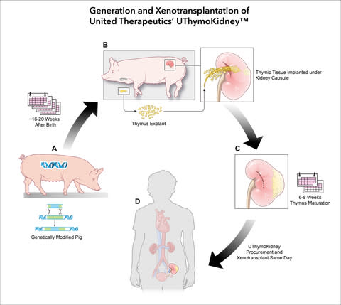 A) Genetically modified source pig, 16 to 20 weeks old. B) The thymus is then explanted from the source genetically modified pig, and the thymic tissue is implanted under its kidney capsule. C) The thymus tissue matures under the kidney capsule for six to eight weeks. D) The UThymoKidney is procured and transplanted into human recipient. (Photo: Business Wire)