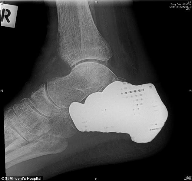An x-ray of Len Chandler's new heel. Image credit: Daily Mail