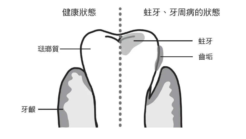 如果不管齒垢，會有什麼下場？