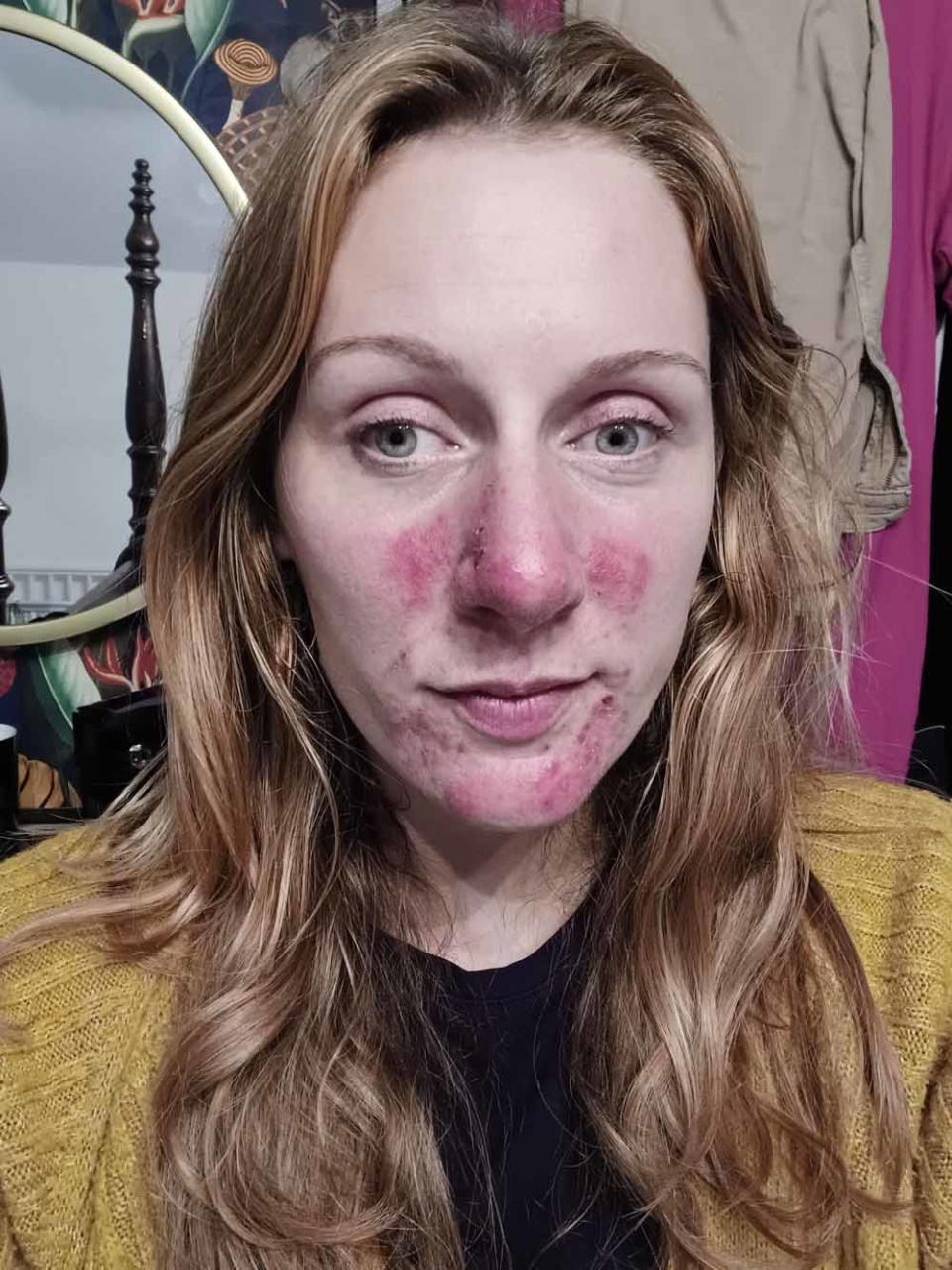 Sarah's skin condition majorly affected her life. (Collect/PA Real Life). 