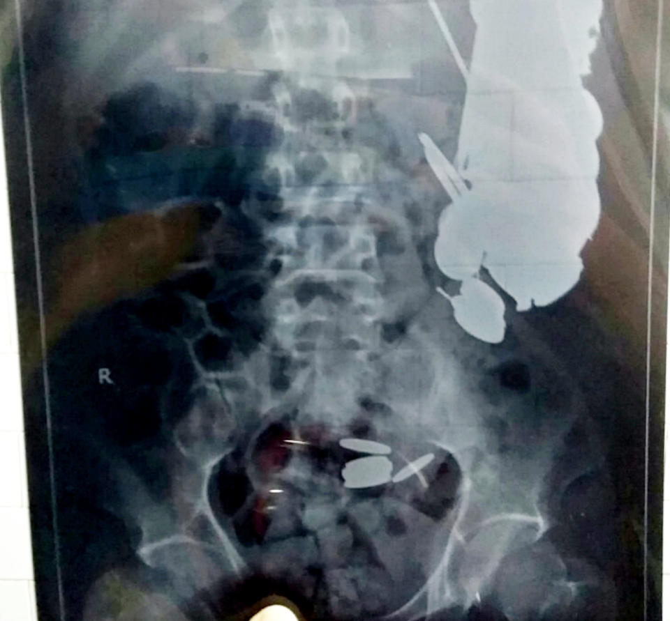 <em>An endoscopy of Mr Khan found hundreds of coins, 1.5kg of nails, dozens of shaving blades, shards of glass, stones, and 6-inch piece of rusted iron shackle (Pictures: SWNS)</em>