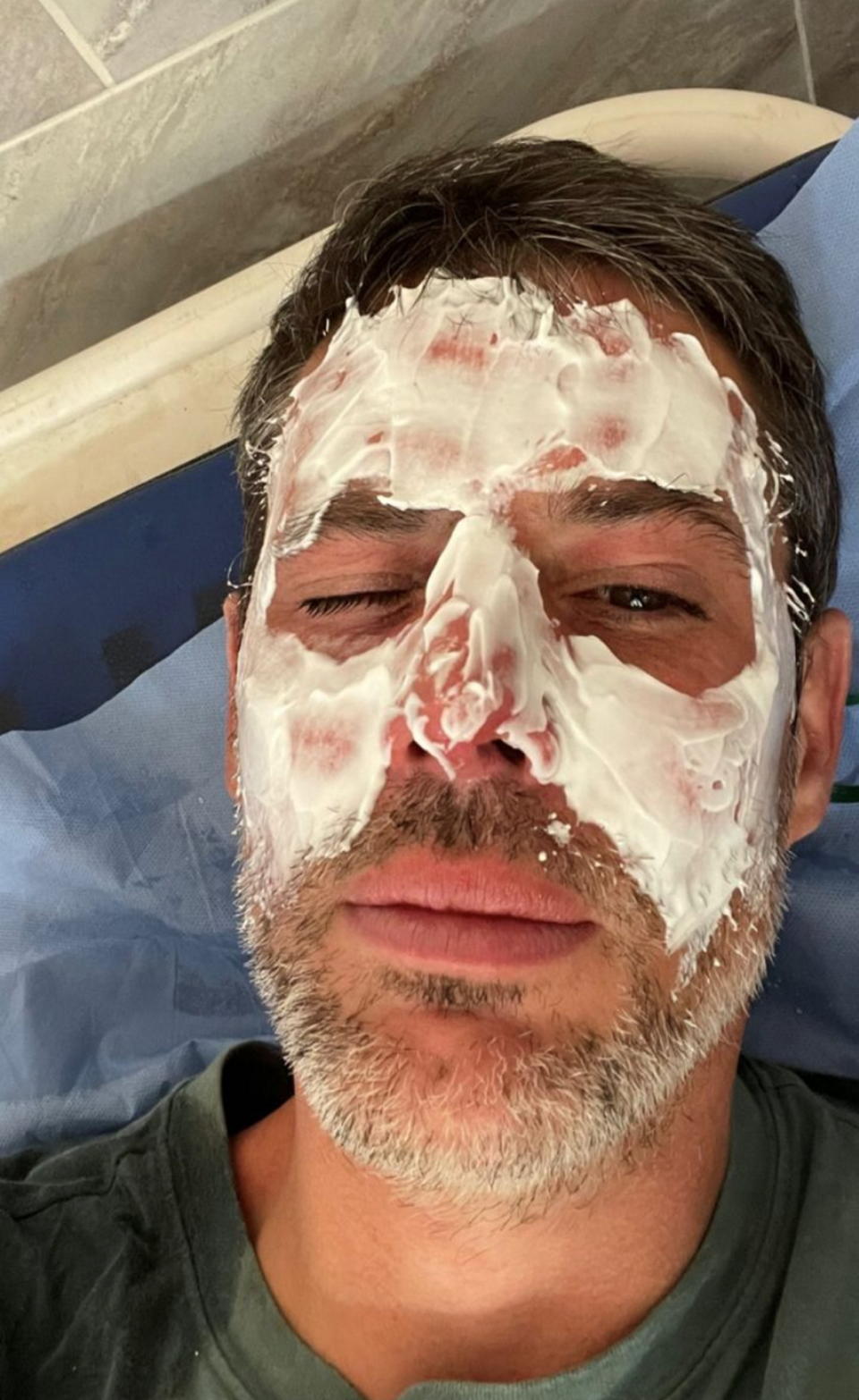 Jérémie Gautrelet's facial burns being treated. (SWNS)