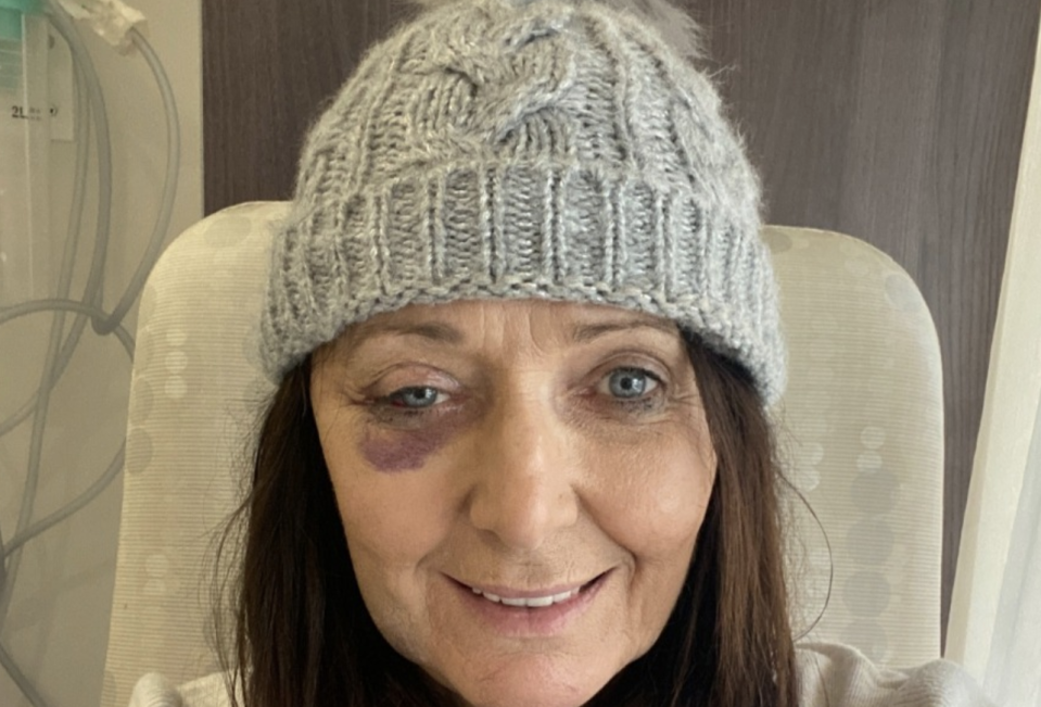 Ms Brown is seen wearing a beanie and featuring bruising around her right eye after the surgery. Source: Supplied