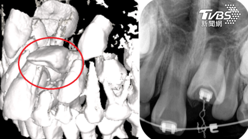 男童的門牙包在牙齦裡。（圖／TVBS）
