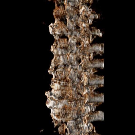 A 3D CT image showing a lateral projection of the thoracic spine of mummified King Amenhotep III (1390–1352 B.C.) diagnosed with diffuse idiopathic skeletal hyperostosis.
