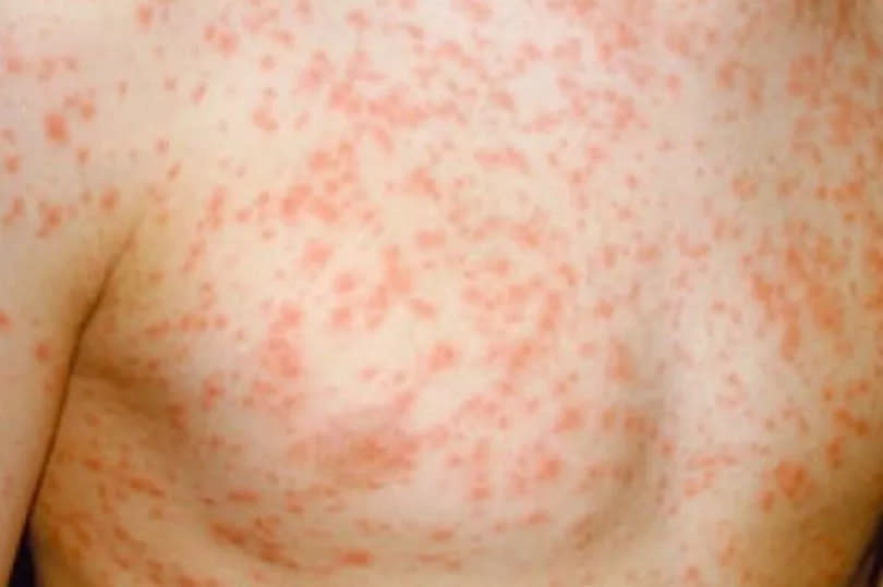 A measles rash -Credit:Copyright Unknown