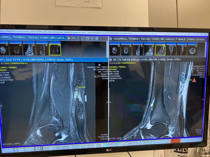 MRI scan of climber Tommy Caldwell's injures Achilles Tendon.