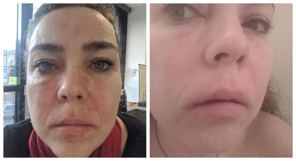 Smith's skin before and after (PA)