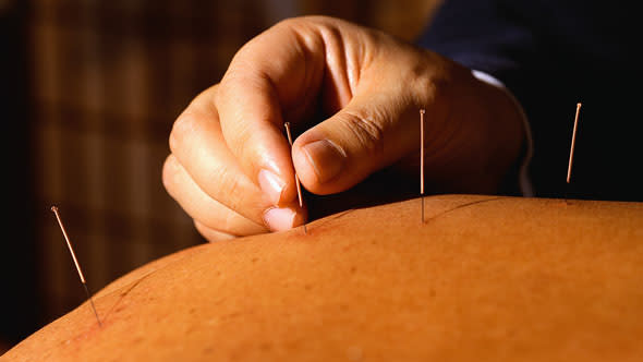 Acupuncture for weight loss