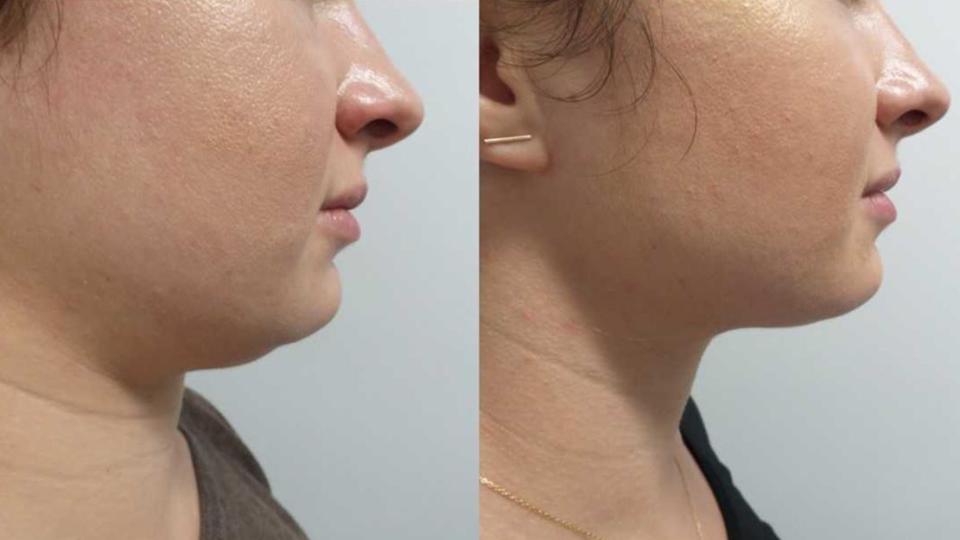two photos showing results of kybella injectable treatment before and after, after two treatments