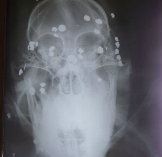 37 pellets lodged in Aan’s head (Orangutan Foundation)