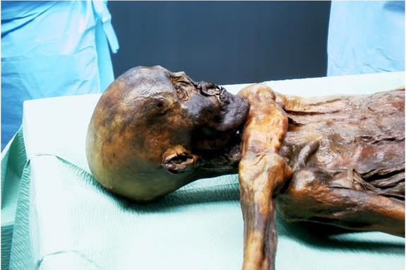 Ötzi the Iceman May Have Suffered Stomach Bug