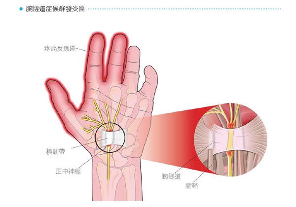 手腕痠痛難耐？1招自我檢測有無「滑鼠手」