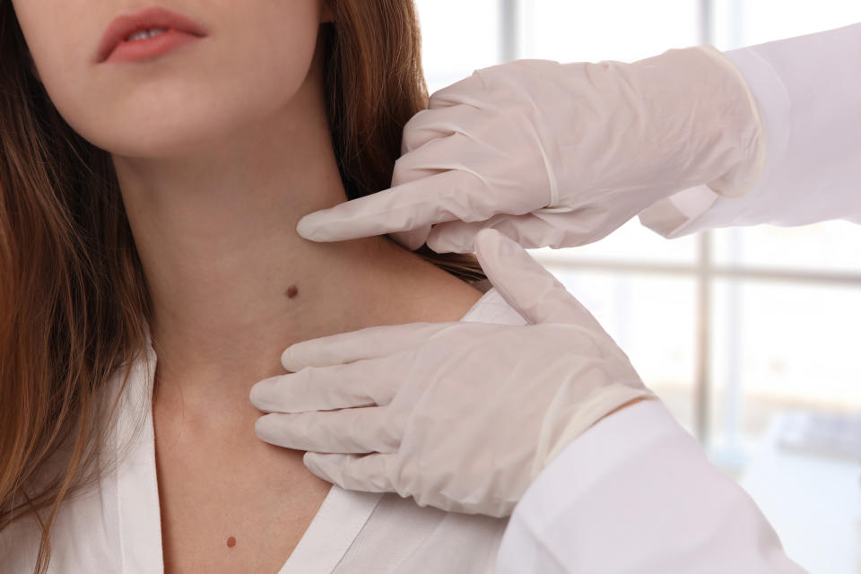 A dermatologist examines a birthmark of patient up close while checking for benign moles. (Getty)