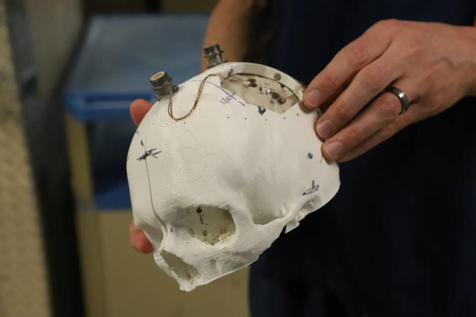 Researchers used a model and functional MRIs to identify where to place the brain implants in Thomas’ skull.