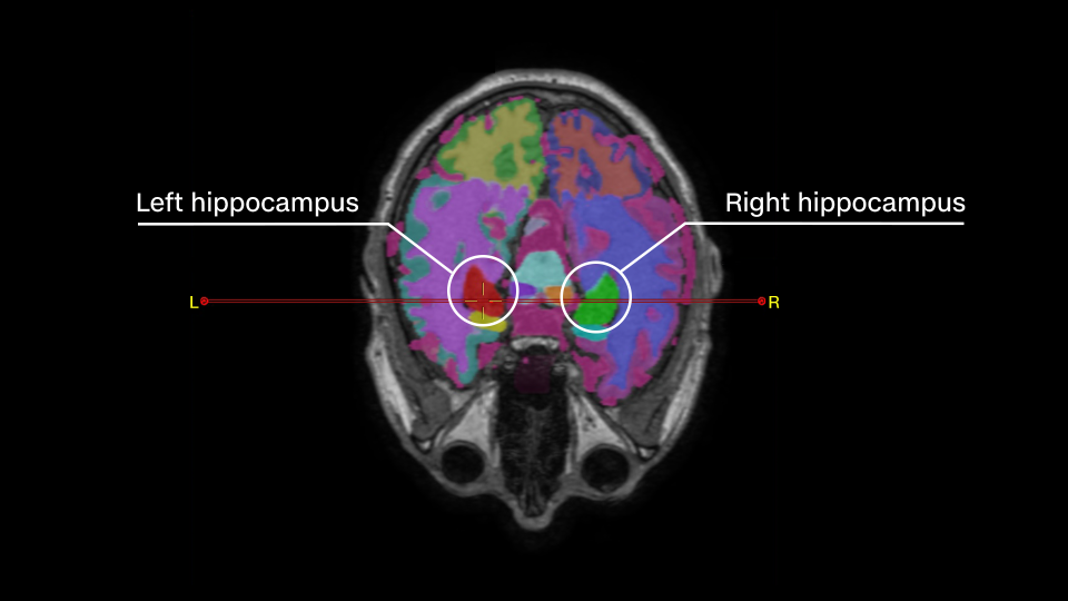 A brain volume image showing the increased size of Nicholls' hippocampus. - CNN/Dr. Richard Isaacson