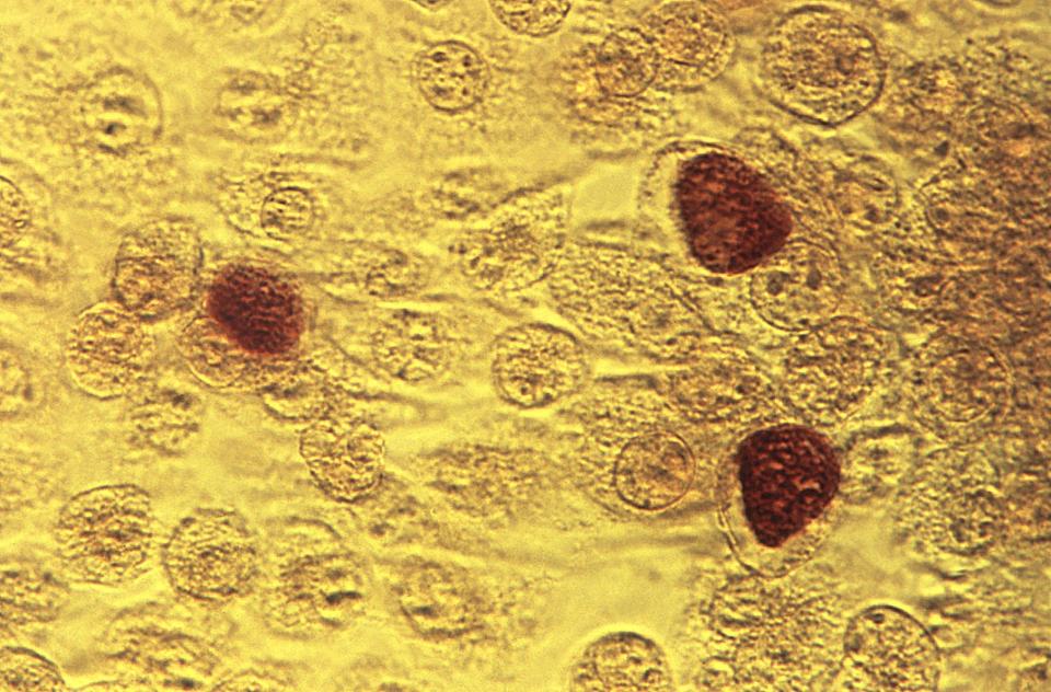This 1975 microscope image made available by the the Centers for Disease Control and Prevention shows Chlamydia trachomatis bacteria.