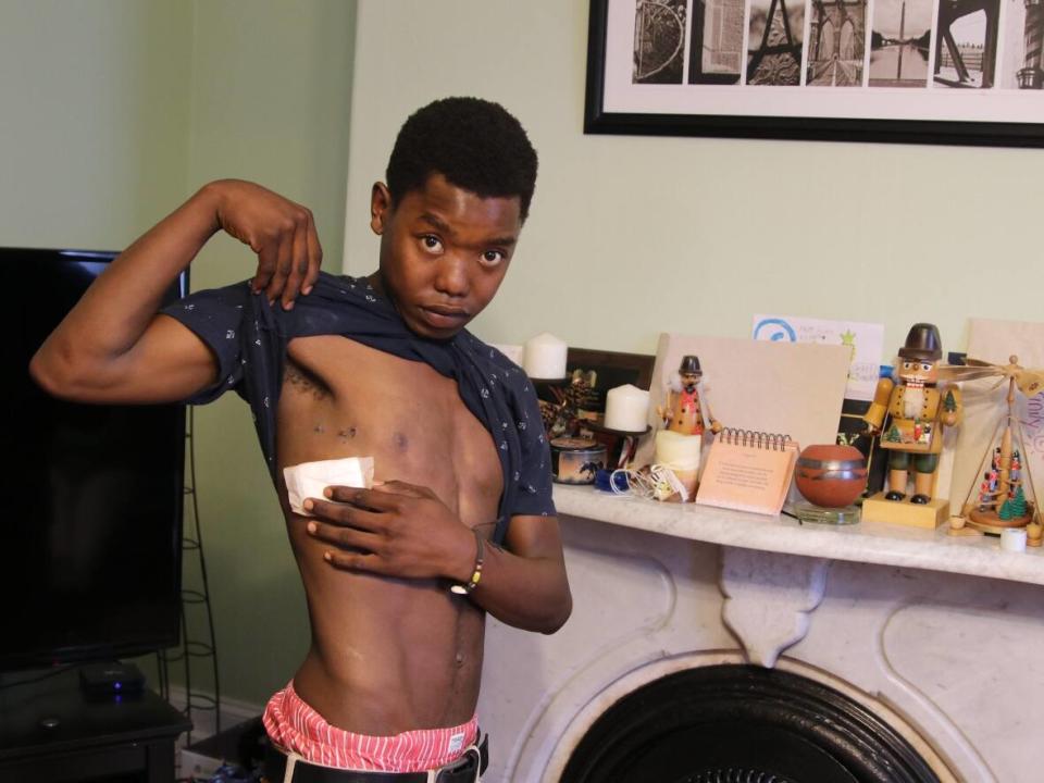 Nhlanhla Dlamini was shot with a nail gun by a coworker on a worksite on Sept. 19, 2018. The nail punctured his lung. He shows the scars from where medical staff inserted a chest tube to release the air that was building up between his lung and his chest wall, causing his lung to collapse.  (Steve Berry/CBC - image credit)