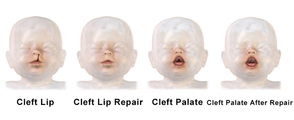 Cleft lip and palate are two of the most common birth defects worldwide. <a href="https://upload.wikimedia.org/wikipedia/commons/0/09/Cleft_Lip_%26_Cleft_Palate_Repair.png" rel="nofollow noopener" target="_blank" data-ylk="slk:BruceBlaus/Wikimedia;elm:context_link;itc:0;sec:content-canvas" class="link ">BruceBlaus/Wikimedia</a>, <a href="http://creativecommons.org/licenses/by-sa/4.0/" rel="nofollow noopener" target="_blank" data-ylk="slk:CC BY-SA;elm:context_link;itc:0;sec:content-canvas" class="link ">CC BY-SA</a>