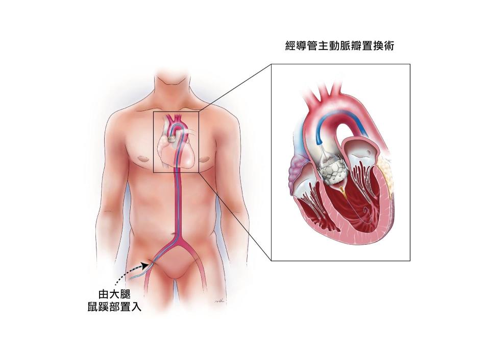 經導管瓣膜置換手術示意圖。長庚醫院提供