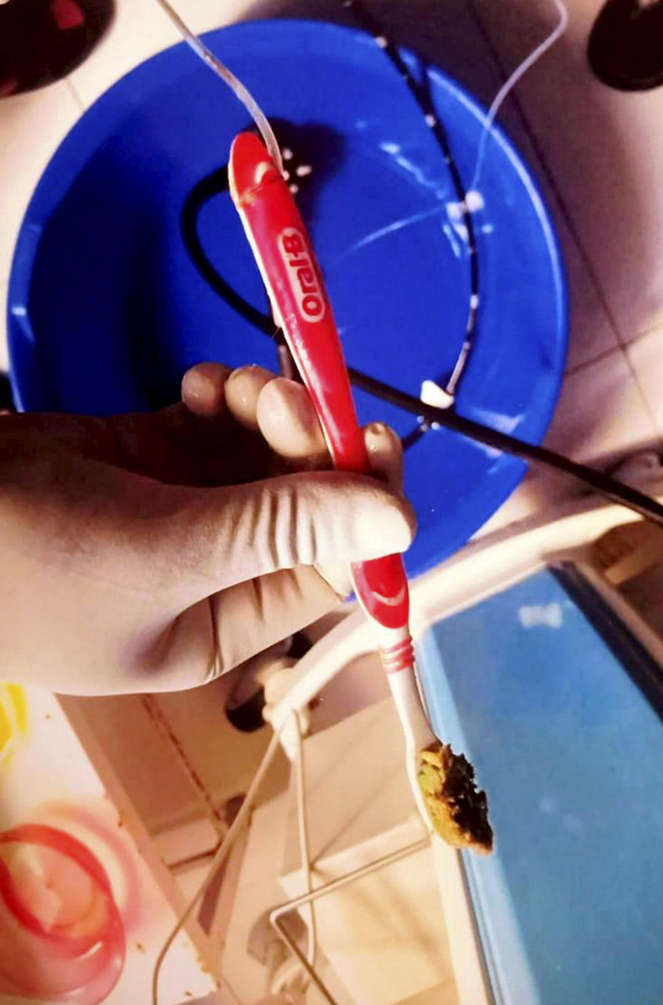 <em>Surgeons spent 45 minutes trying various methods to remove the toothbrush and finally got it out (Picture: SWNS)</em>