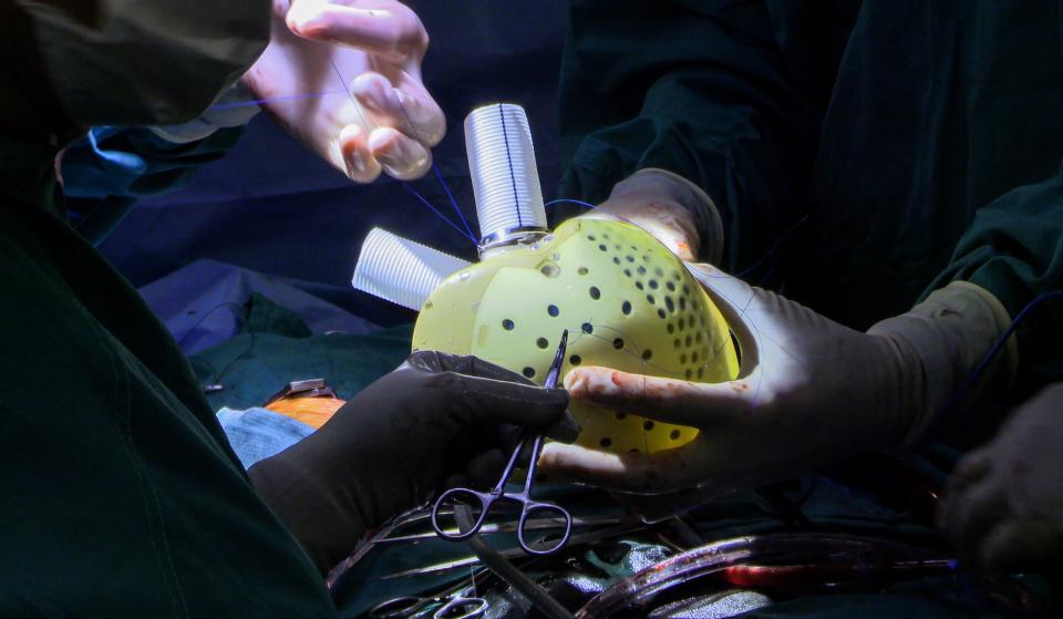 Artificial heart gets transplanted