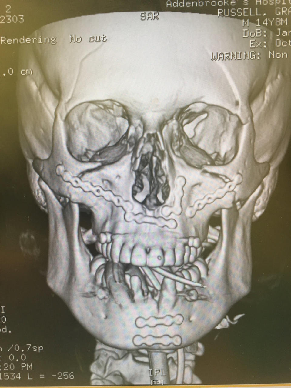 <em>Surgery – doctors spent five hours restoring Grady’s facial structure</em>