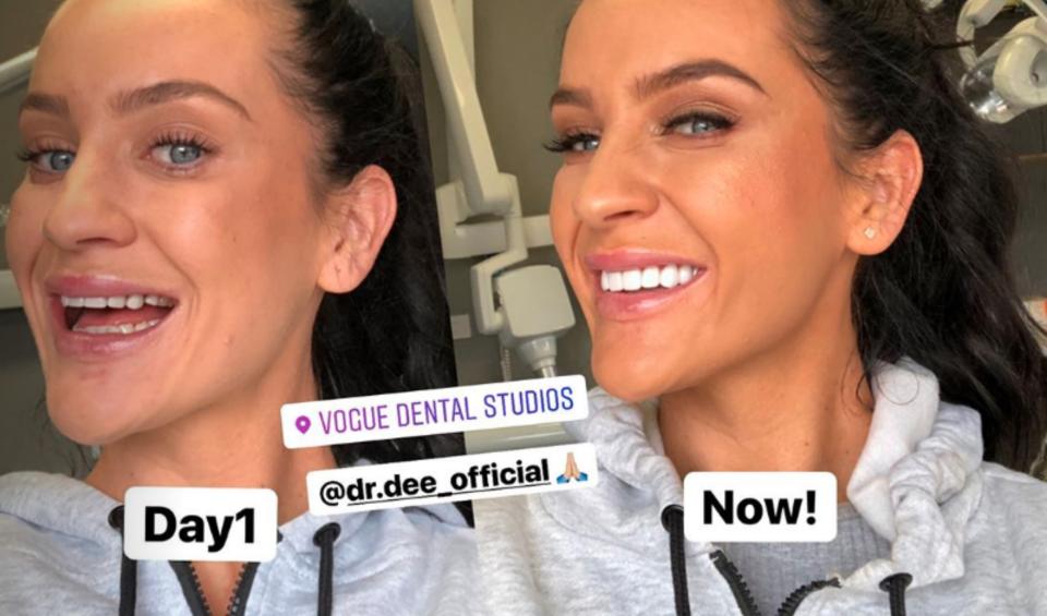 The reality star had the work done at Vogue Dental Studios in Melbourne. Photo: Instagram/ Ines Basic