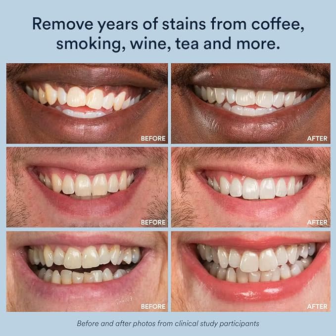 Teeth Whitening Before and After