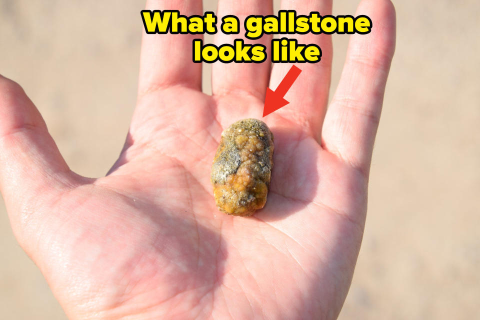 A gallstone in a person's hand