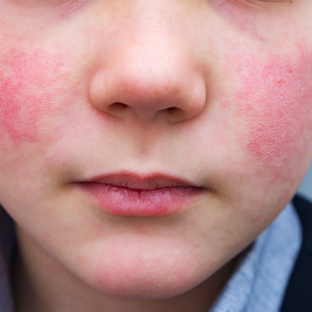 a common symptom of fifth disease is rash 