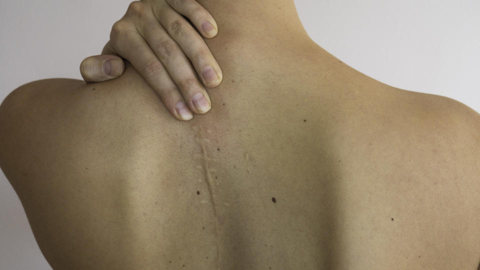 a scar on a woman's back