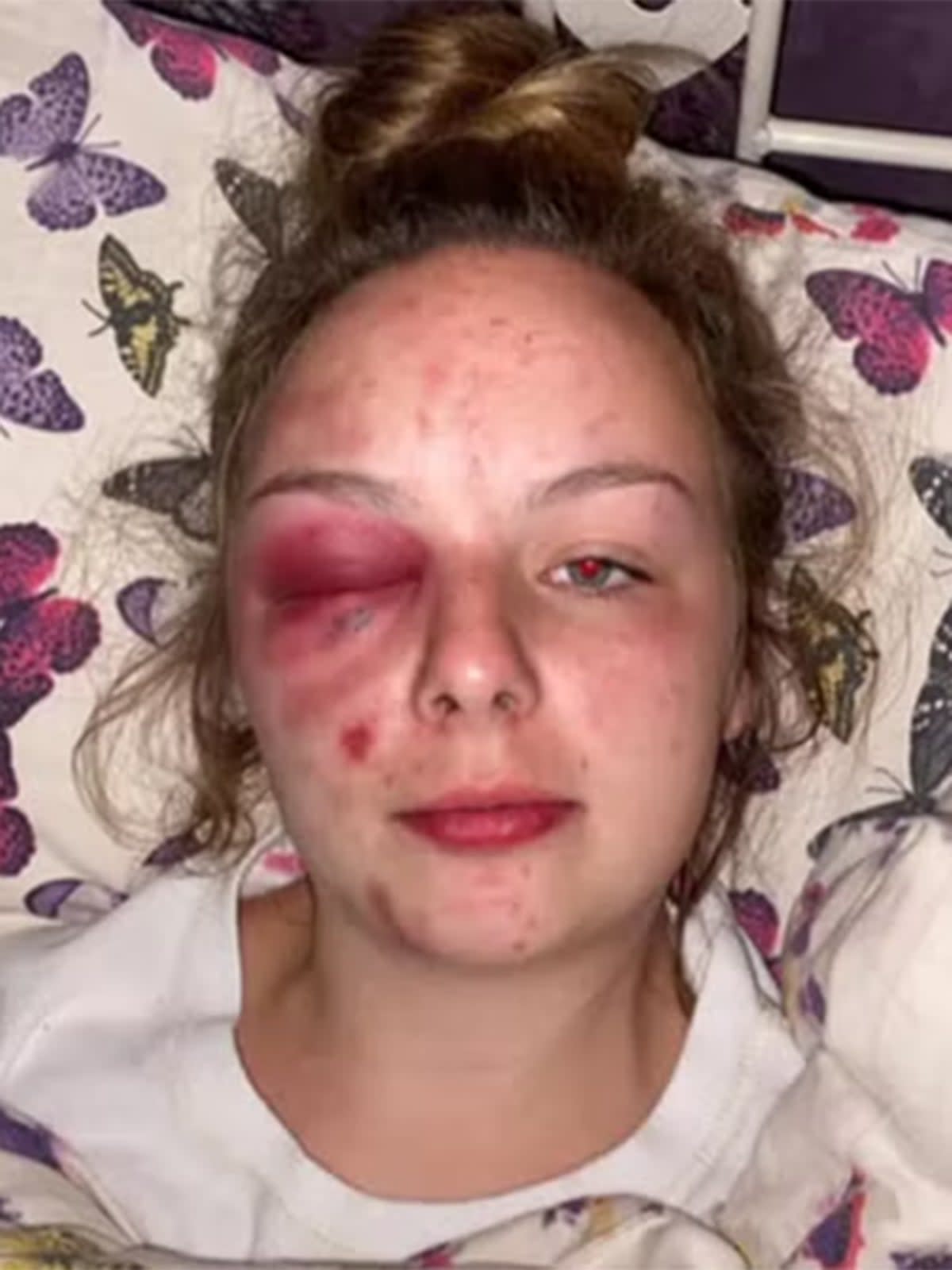 Eleanor Williams shared pictures of her injuries but they were self-inflicted (Handout)