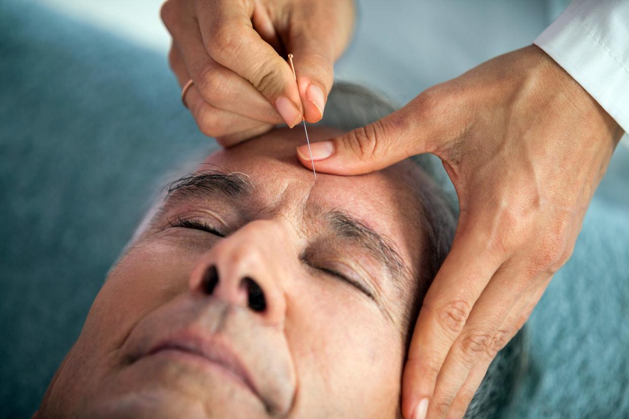 Man getting acupuncture on his forehead