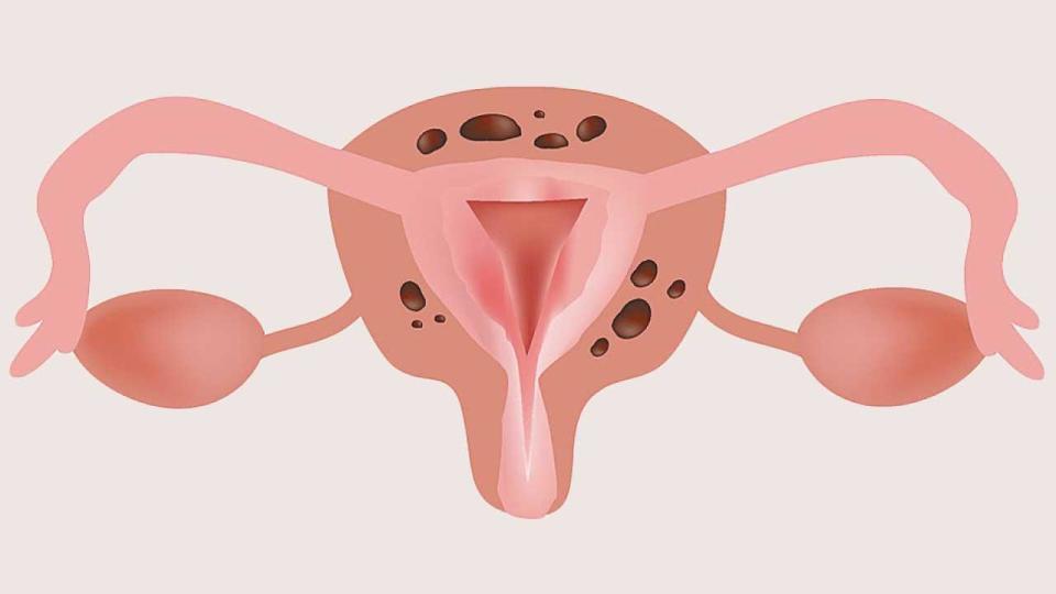 Adenomyosis or pregnancy complication?