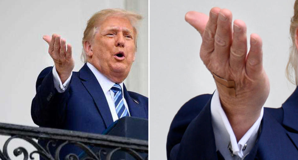 US President Donald Trump speaks at the White House with a bandage seen on his right hand.