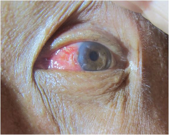 The surfer's eye 3?days after injury shows the pterygium on the cornea is cleared and there is mild local inflammation.