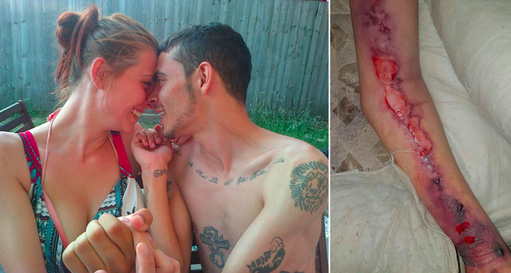 Katie Widdowson's arm became infected after a sex game with her boyfriend Dean Smith (SWNS)