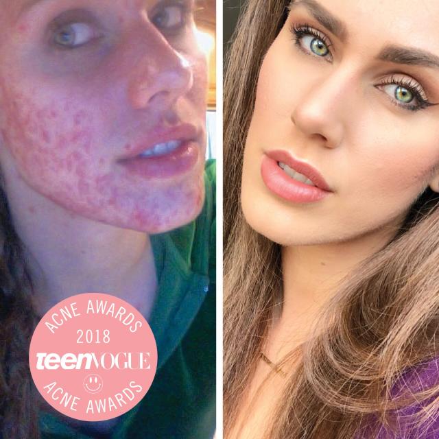 Cassandra Bankson On The Truth Behind Her Cystic Acne 