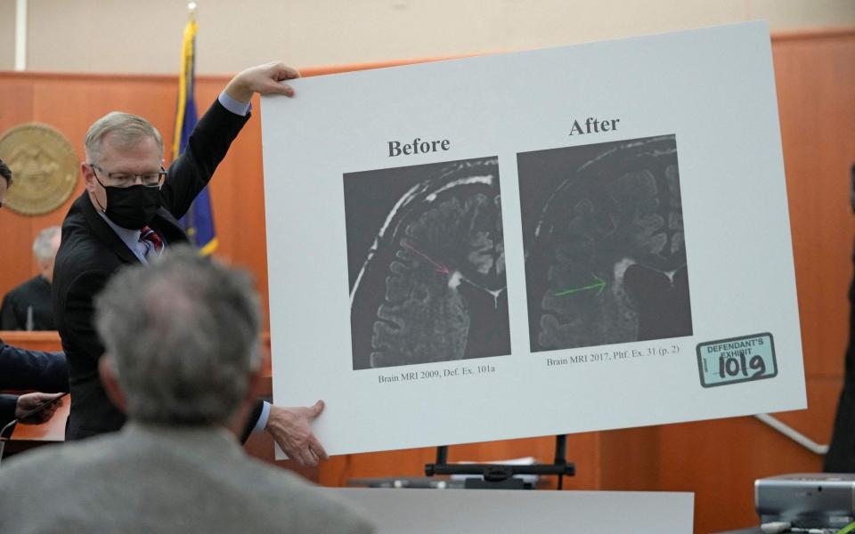 Steve Owens, Paltrow's attorney, holds up a poster showing a brain scan during the court hearing - Rick Bowmer/AFP via Getty Images