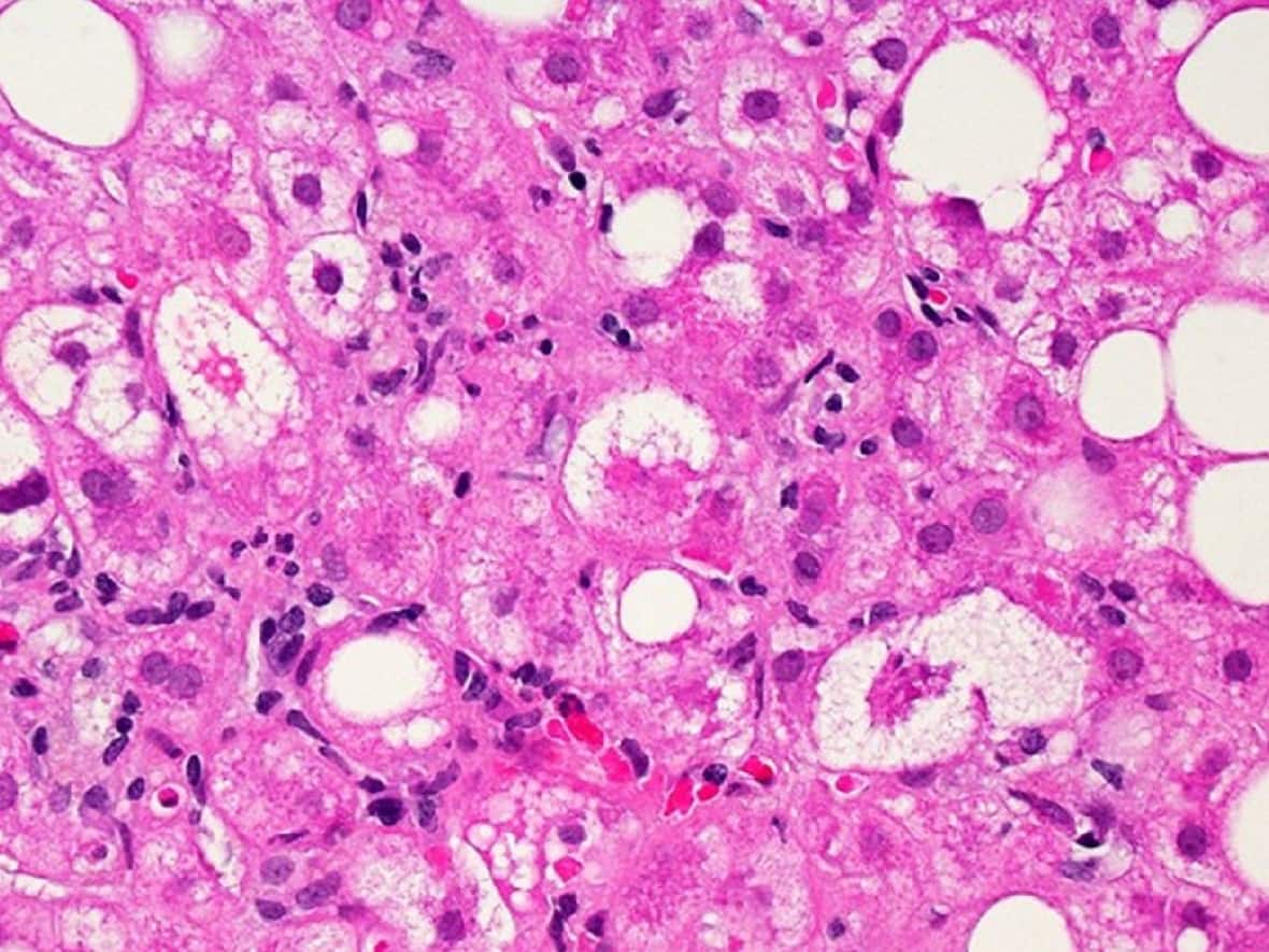A microscopic image of liver tissue. Cases of unexplained hepatitis, or liver inflammation, are being investigated around the world. Ten such cases have been confirmed in Canada, officials said Friday.  (National Institutes of Health - image credit)