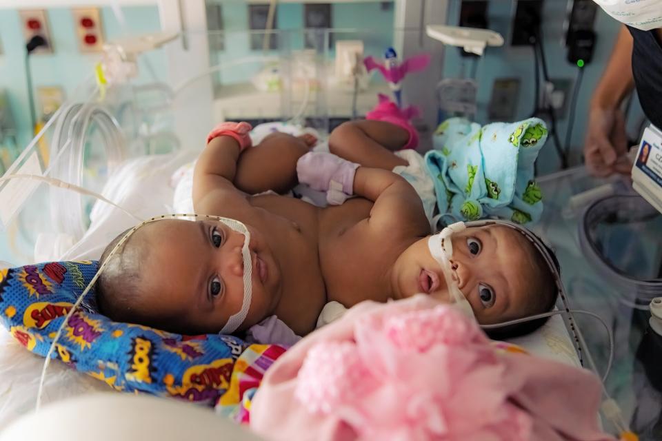 JamieLynn and AmieLynn, Conjoined Twin Girls Separated at Cook Children’s Medical Center Make History