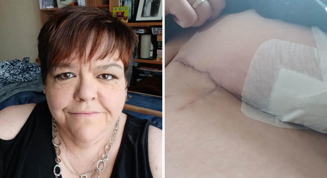 Sylvia Halcrow believes a scratch caused by the underwire in her bra lead to a flesh-eating bug. (SWNS)