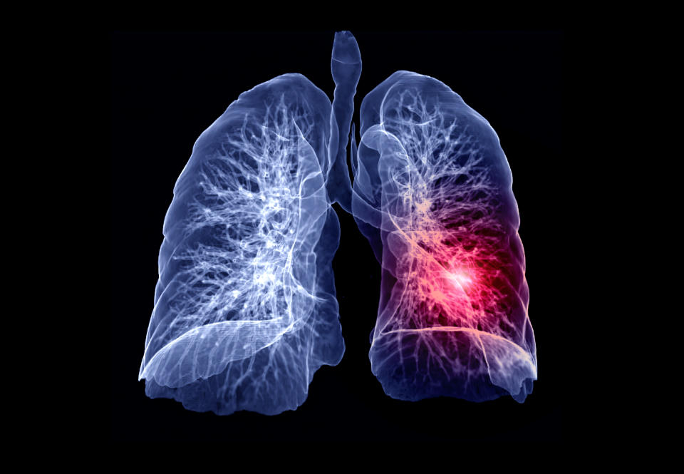 CT Chest or Lung 3D rendering image showing lesion left area for diagnosis TB,tuberculosis and covid-19 .