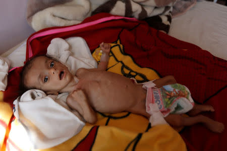 A malnourished boy lies on a bed at a malnutrition treatment center in Sanaa, Yemen November 21, 2017. REUTERS/Khaled Abdullah