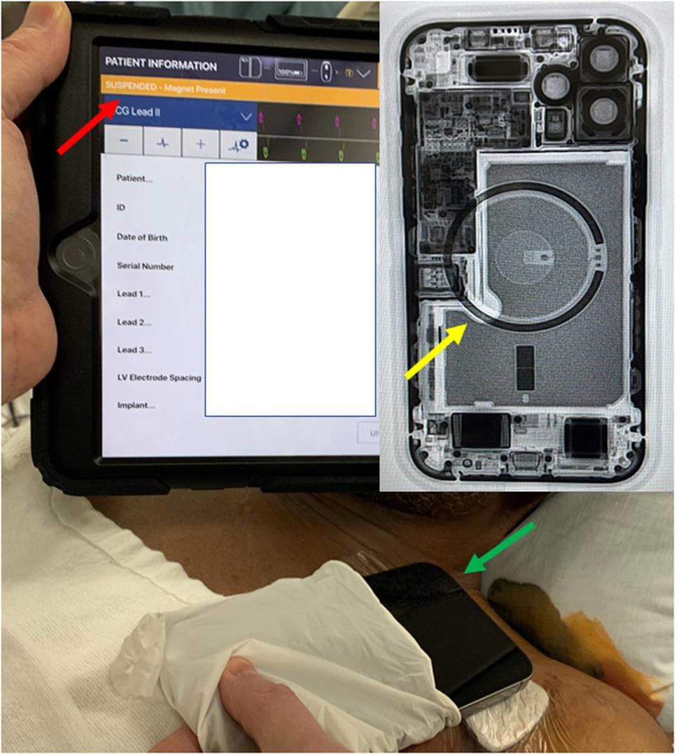 Device programmer showing the suspension of an implanted defibrillator (orange bar, red arrow) with an iPhone 12 laying over a patient’s chest (green arrow), as well as a fluoroscopy of the Phone 12 showing the circular magnet array.