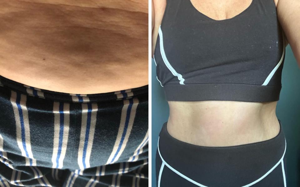Justine saw the cellulite on her stomach 'disappear' after a few sessions of lymphatic drainage