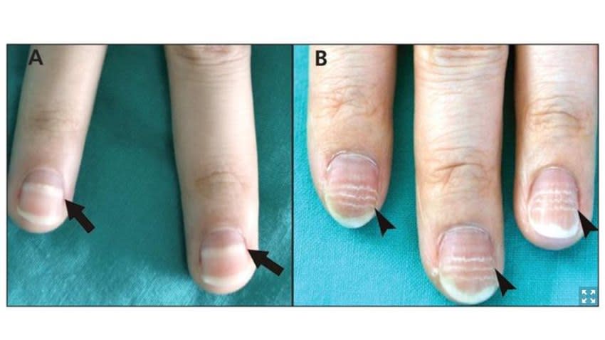 指甲也能看出有沒有染疫？醫師揭COVID-19患者指甲4大特徵