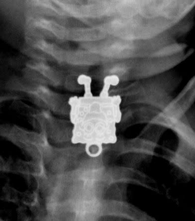 A toddler in Saudi Arabia swallowed this Spongebob pendent.